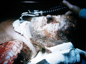 3 weeks after the accident