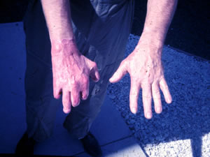 amputated distal joint